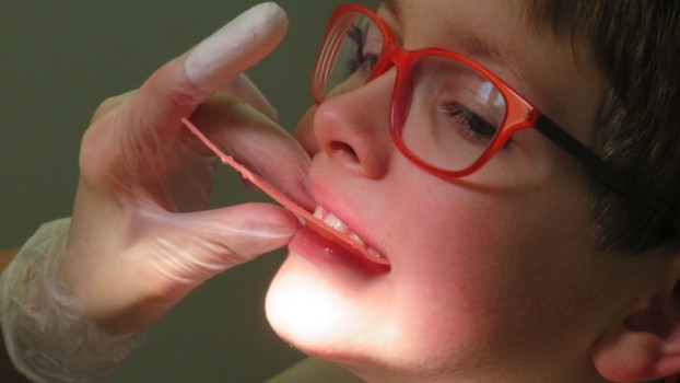 5 sfaturi pentru pregătirea copilului înainte de fixarea aparatului dentar